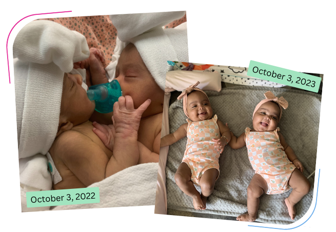 A Milestone Birthday: Once Conjoined Twins Turn 1 Featured Image