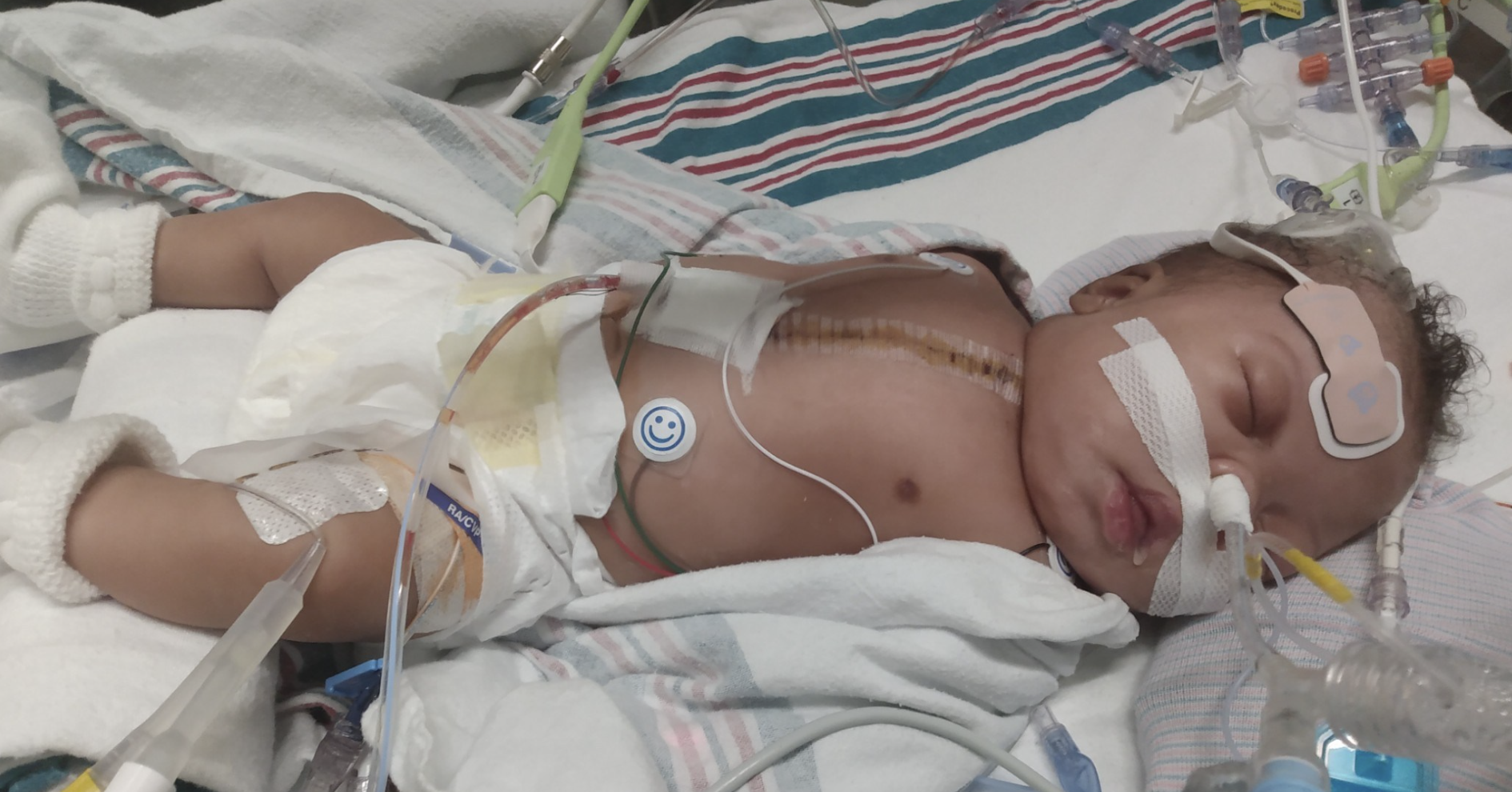 Defying the Odds: 1.3 Pound Newborn Undergoes Complex Open-Heart Surgery Featured Image